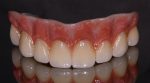 Arcadas completas de zirconia - Image 7
